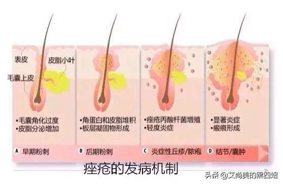 怎样预防痘痘脸教你5个小秘诀,怎么预防和治疗痘