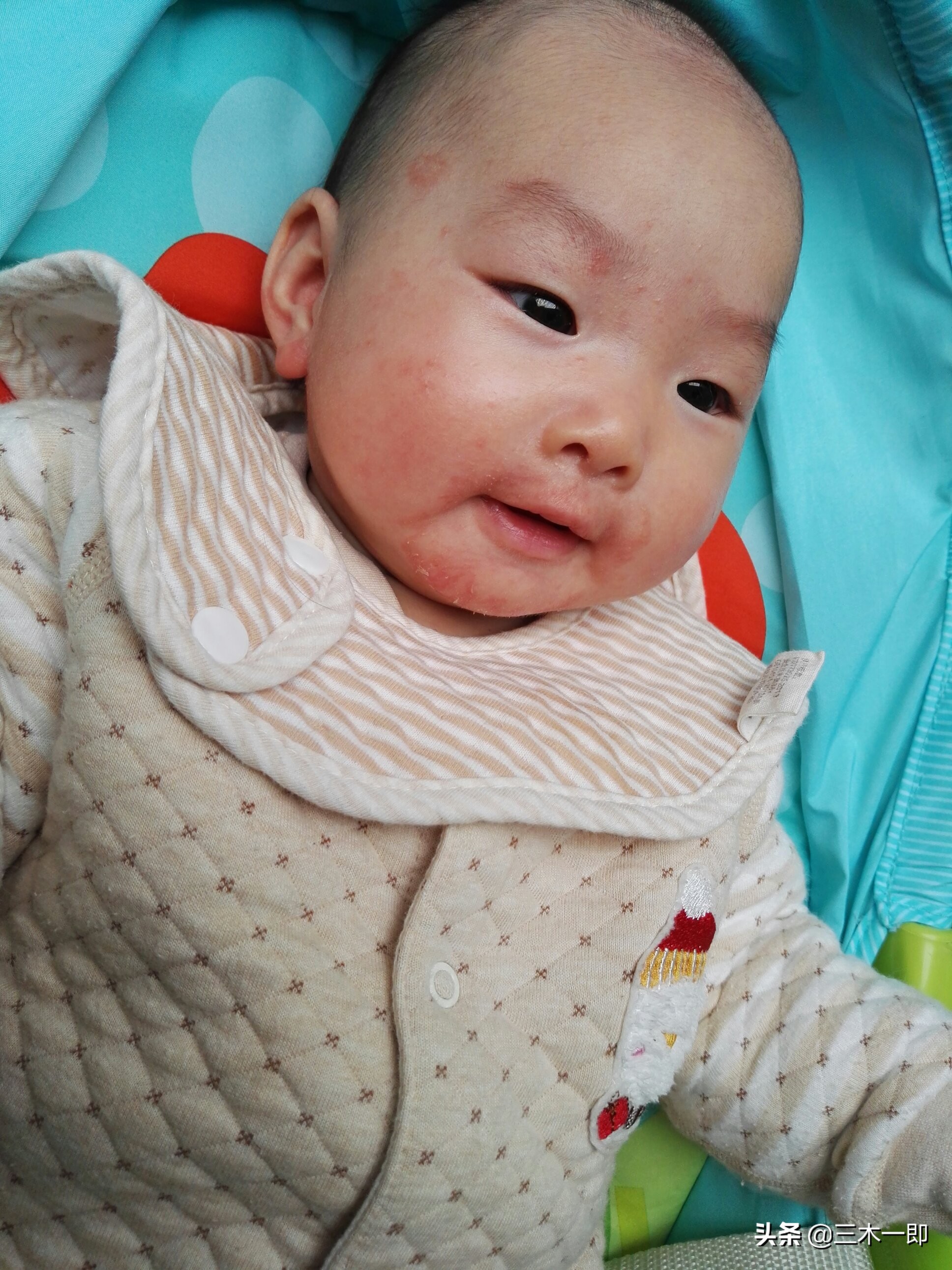 孩子湿疹的原因及处理方法,儿童湿疹治愈过程