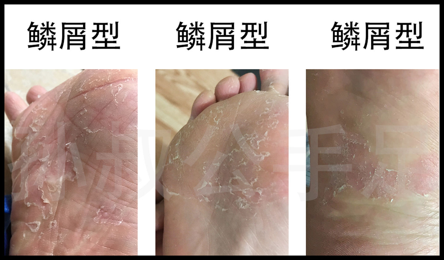 脚气脚臭脚痒的治疗方法小妙招,有脚臭脚痒裂口的脚气症状怎么治