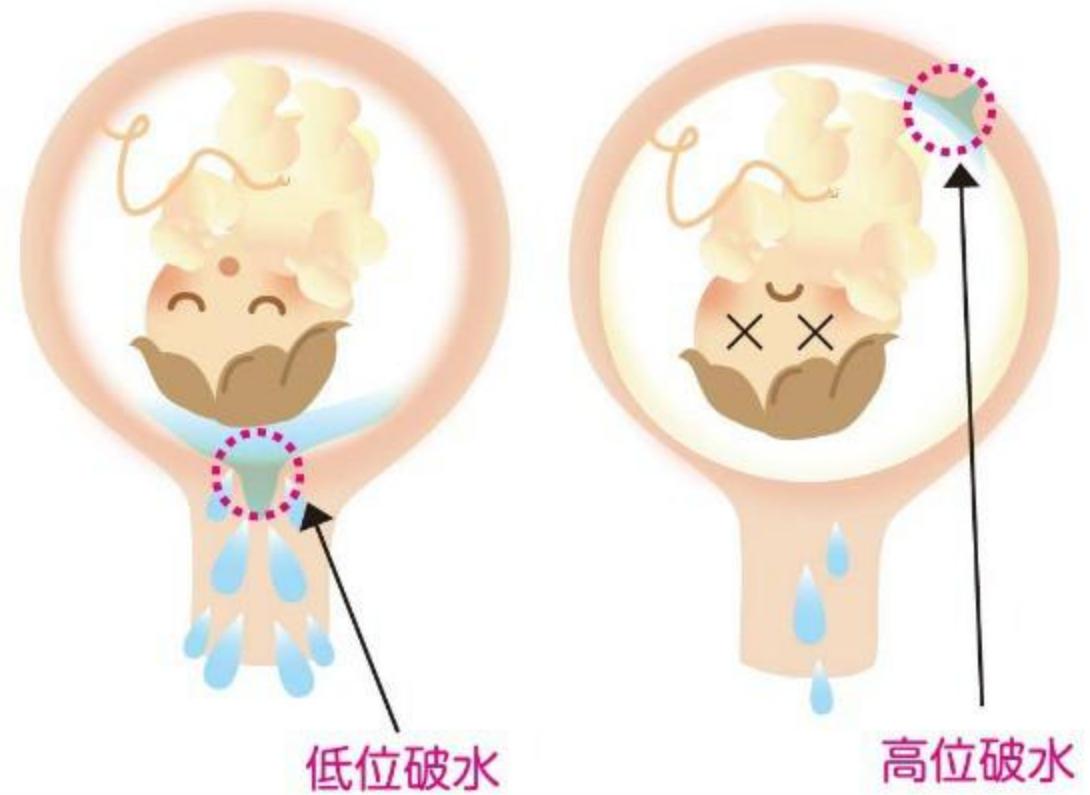 单绒双羊37周需要提前住院待产吗,孕妇最多可以提前多少天住院待产