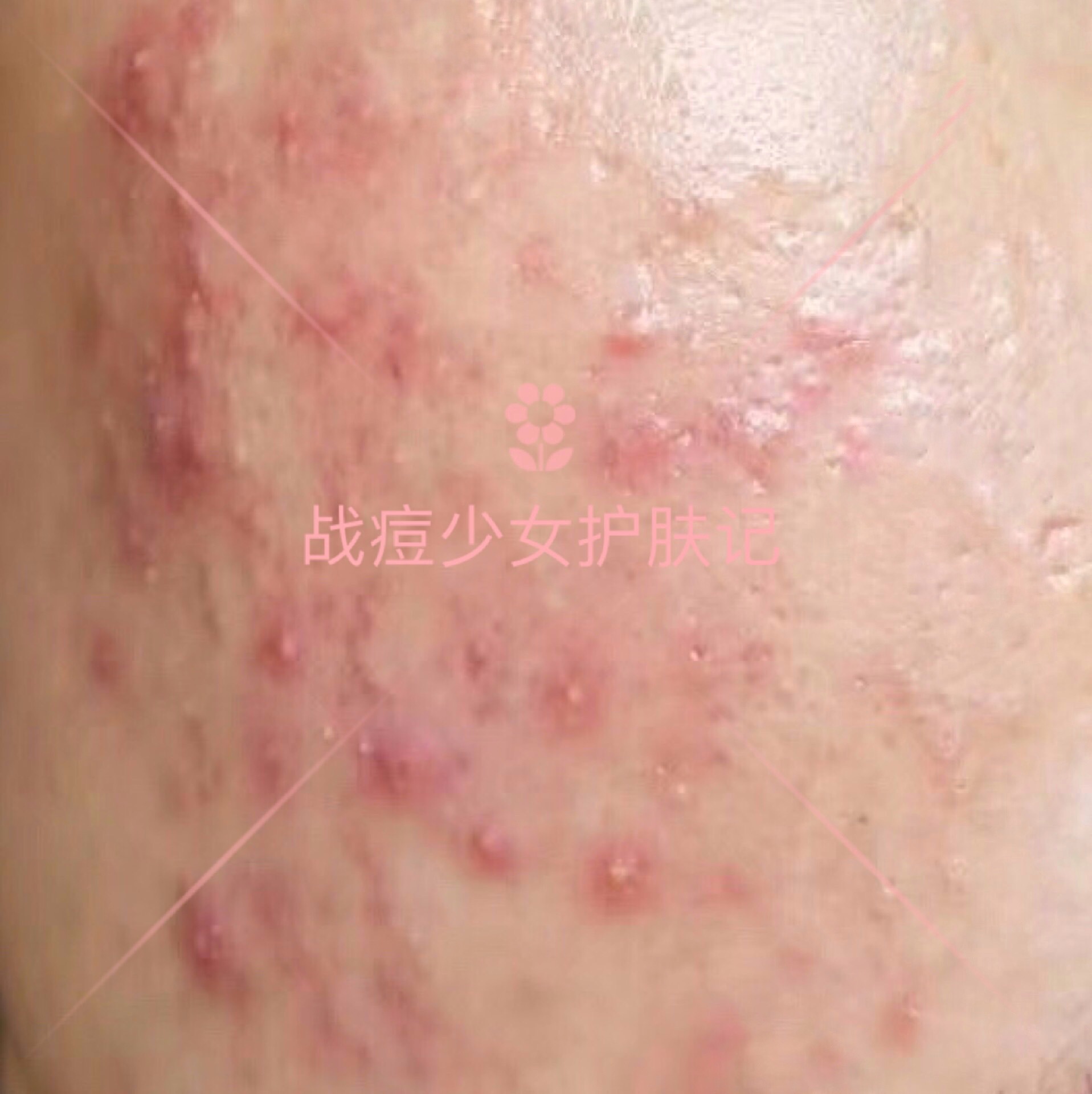 6种痘痘对号入座，1分钟教会你认清痘痘类型，对症战痘！