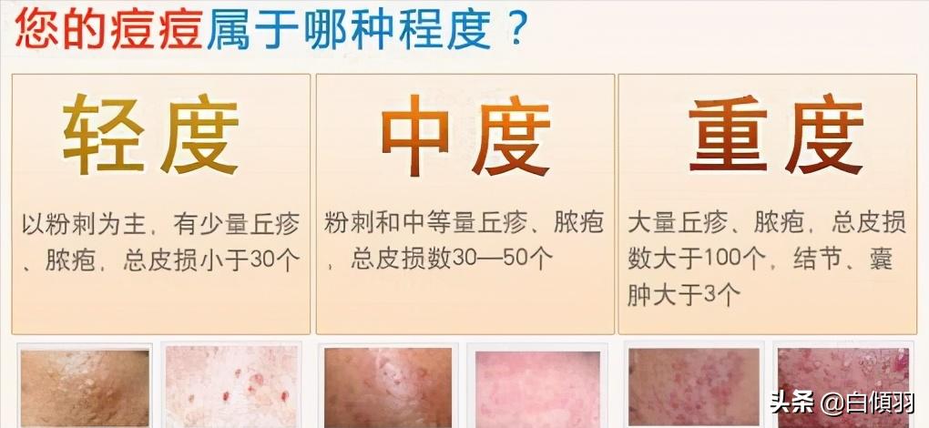 痘痘红肿发硬但是没白色脓头很疼,红肿痘痘疼不冒头也不消怎么办