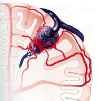 脑血管先天性畸形怎样治疗,老年人脑血管畸形的治疗方法