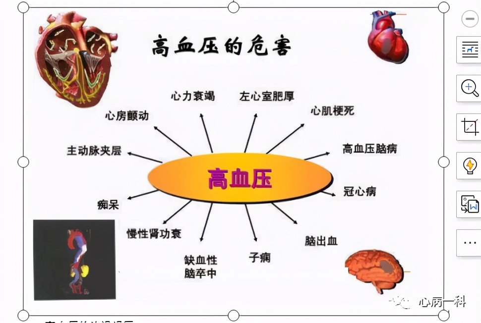 对高血压患者的生活方式指导,高血压患者体重管理