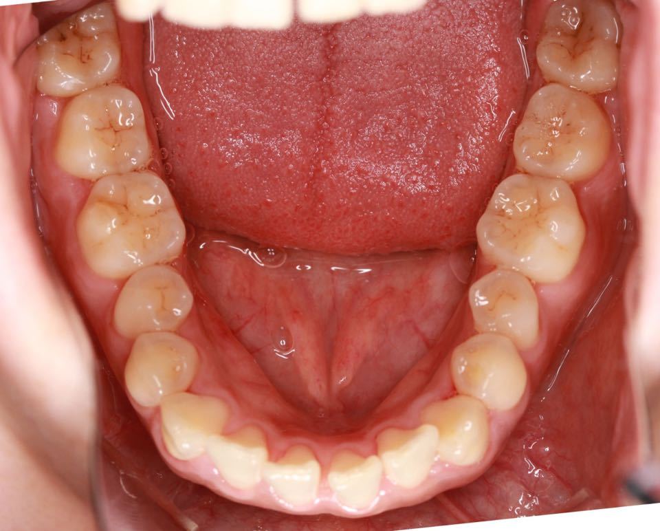 西安张军正畸医生如何,西安牙齿矫正案例