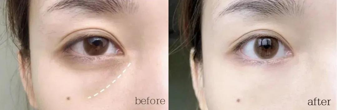 真牛！松弛老态的眼周，都被“马应龙”治住了