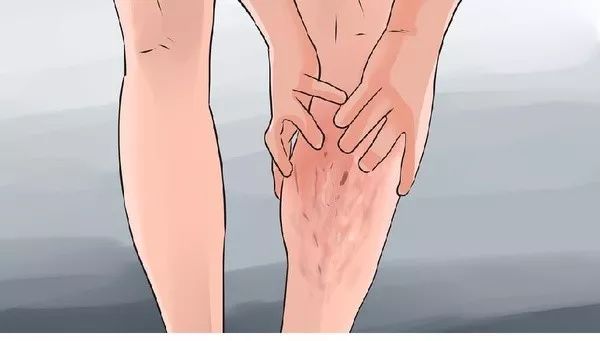 微创静脉曲张全国专家,治疗静脉曲张最新科技