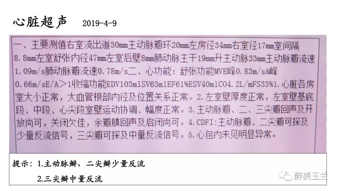 病例分享丨三叉神经节微球囊压迫术的麻醉管理