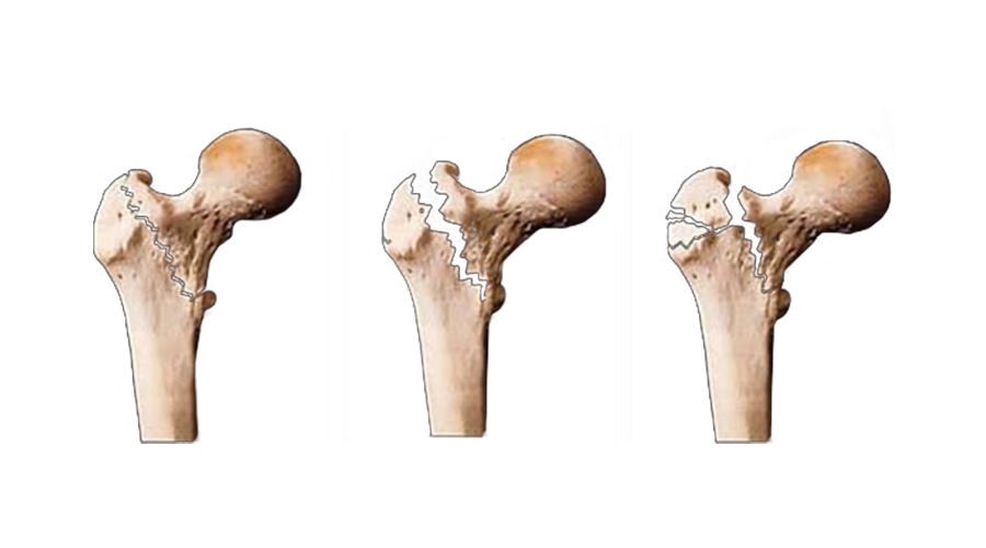 得了股骨头坏死必须拄拐吗,股骨头坏死换关节医保报销多少