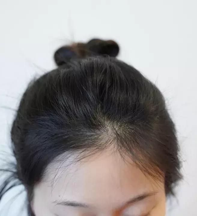 扁头怎么让头变得饱满些,扁头怎么办最快最有效