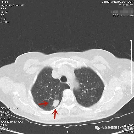 叶建明谈实性结节,叶建明肺实性良性结节会变癌症吗