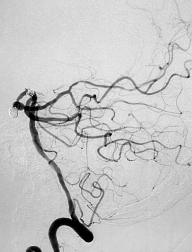 卢旺盛：脉瘤和基底动脉动脉瘤裸栓治疗术后效果非常明显