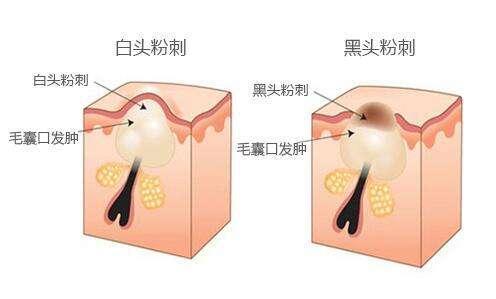 白天身上螨虫多是什么症状,身上螨虫多影响护肤吗