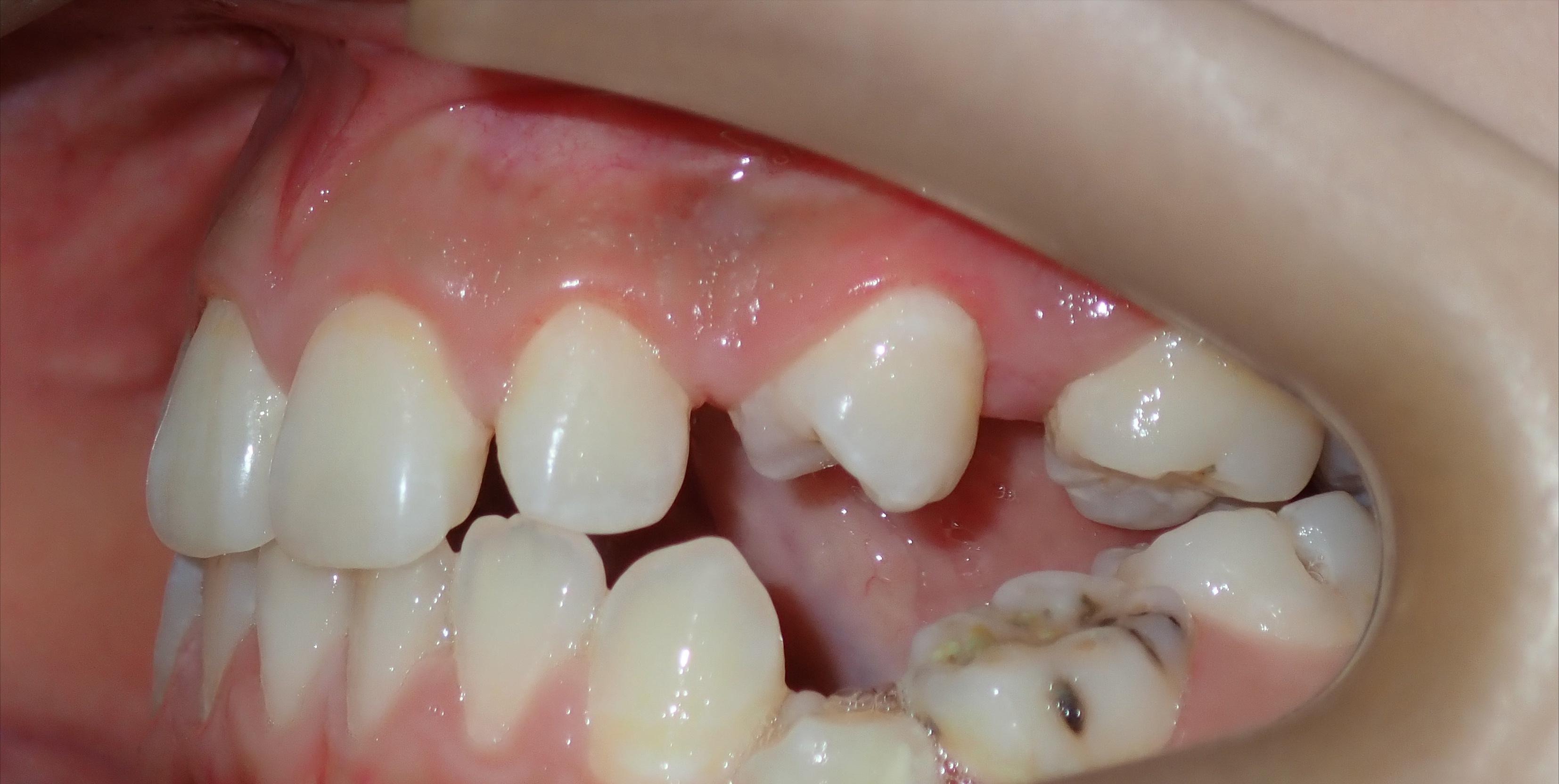 缺牙长期一侧咀嚼嘴巴倾斜,缺牙对咀嚼的影响