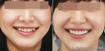 淄川口碑最好的矫正牙齿医院,淄博市口腔医院哪个专家整牙好