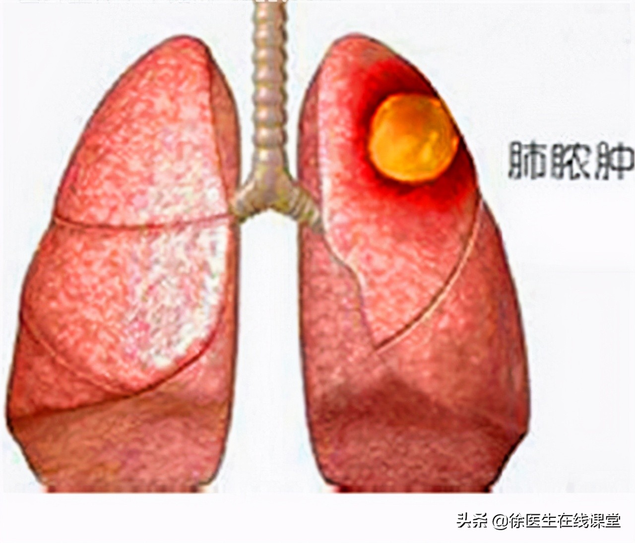 肺脓肿是局限性化脓性炎吗,急性肺脓肿与其他疾病鉴别