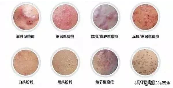 「纯干货」了解痘痘的类型，教你怎么控制痘痘