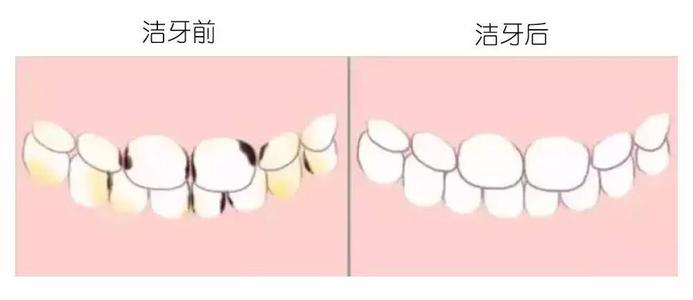 宝宝牙齿上黑点是蛀牙吗,宝宝牙齿有黑点怎么挽救