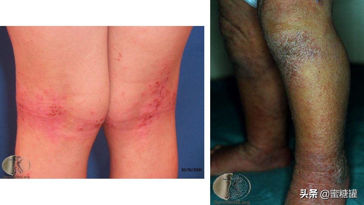 异位性湿疹吃什么药好,皮肤病湿疹痒吗