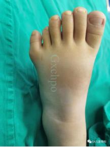 健康学堂丨多指（趾）未必多福！及早就诊才是最佳选择