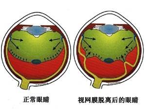 经常熬夜视网膜会脱落吗,熬夜视网膜会掉吗