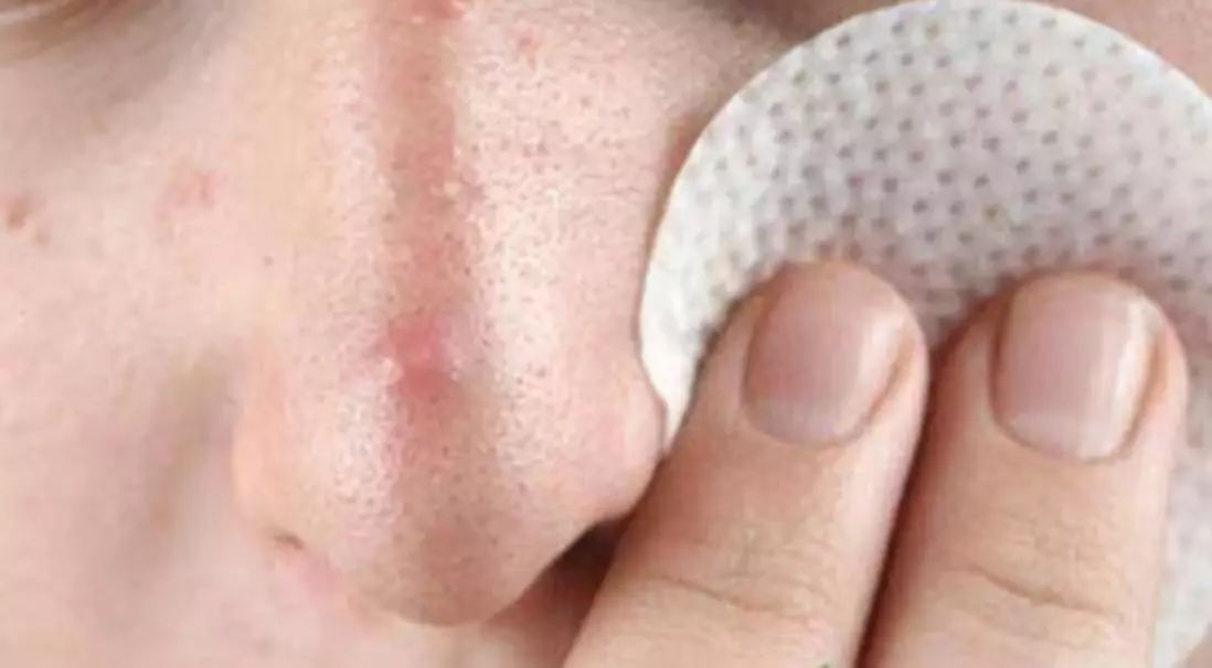 小孩鼻头长痘红肿是啥原因,鼻头长痘红肿怎么消除