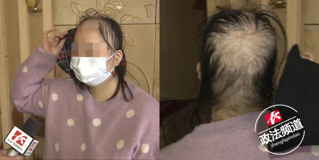 女子养发养到秃顶后续结果,女子美容院养发变秃头