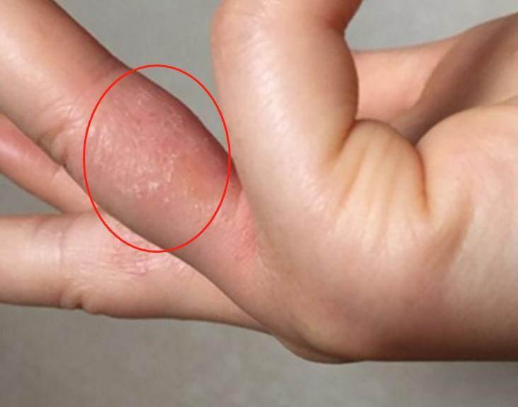 脚趾缝里面长个黄色水泡超级痒,脚趾缝长水泡脚趾缝糜烂奇痒无比