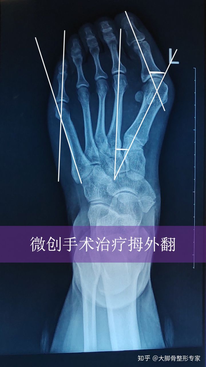 女生为什么会有大脚骨和小脚骨,大脚骨和小脚骨突出怎么办呢