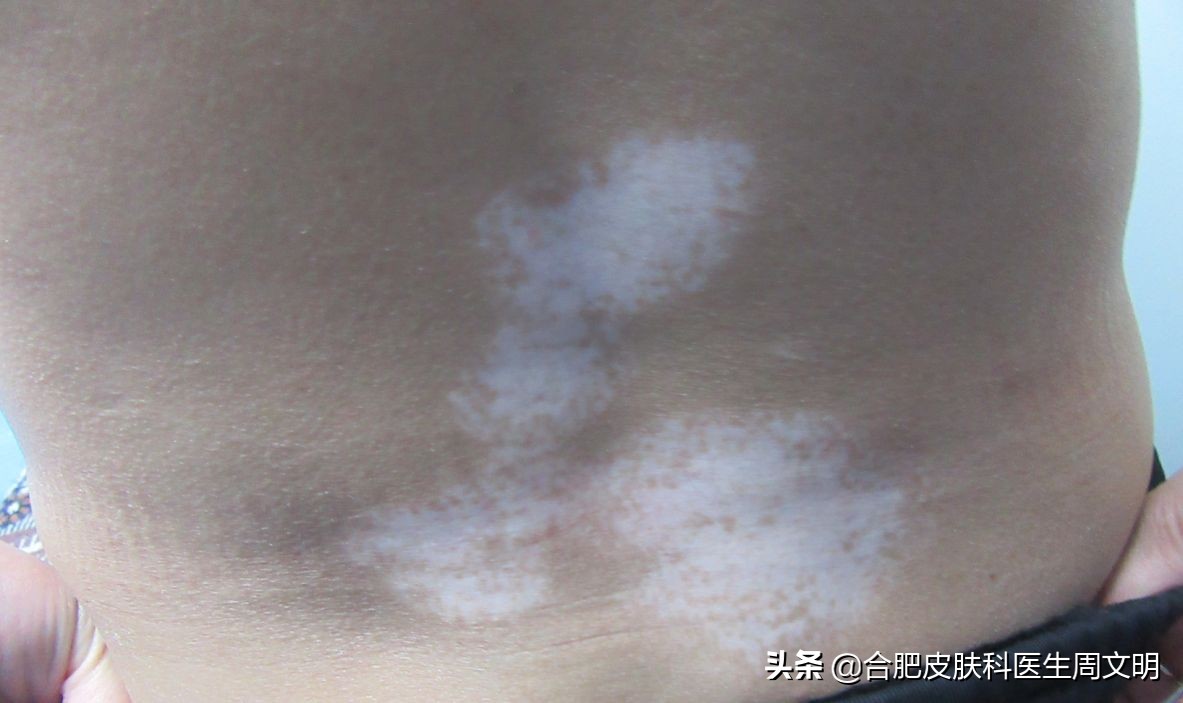 白癜风是皮肤病难治的第几种,鼻子下方嘴巴上的白癜风难治吗