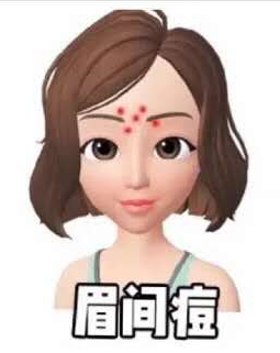 鼻翼两侧和下巴长痘什么原因引起,脸颊两边长痘是什么原因该怎么办