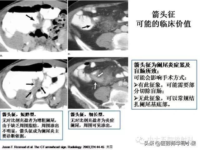 阑尾炎课件,阑尾炎的超声课件