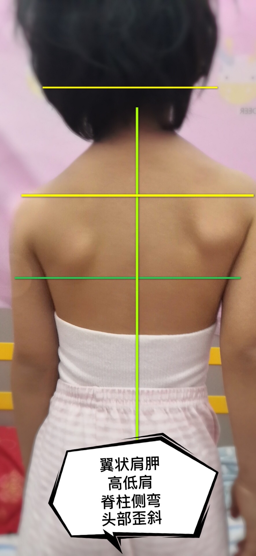 小朋友圆肩驼背脊柱侧弯，调整翼状肩胛，28天回到年轻身体姿态