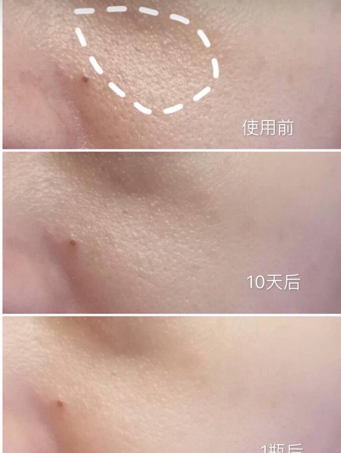 收毛孔有效的果酸产品,可以收缩毛孔的低浓度果酸