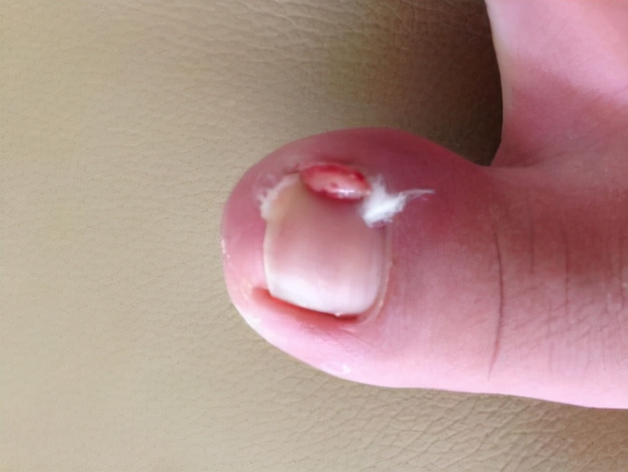 脚趾甲长进肉里会痛怎么办甲沟炎,脚趾甲老往肉里钻一碰还疼