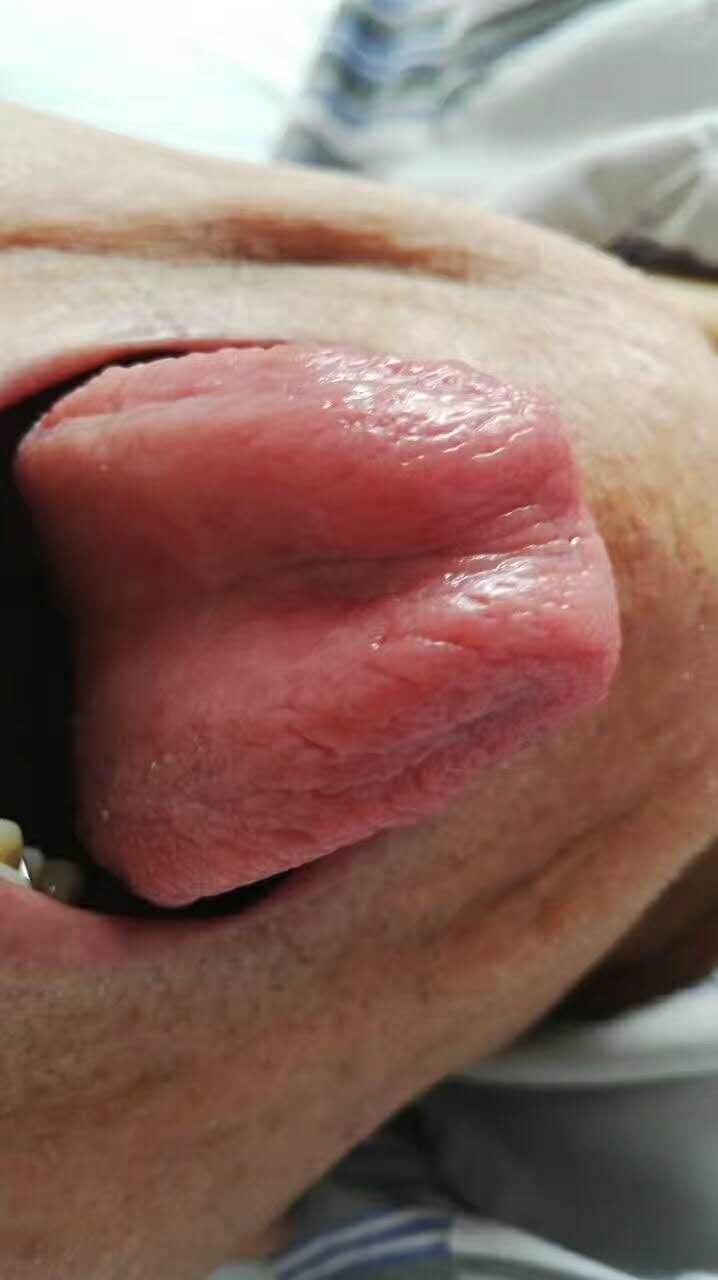 痴呆自己能感觉出来吗,痴呆能好吗