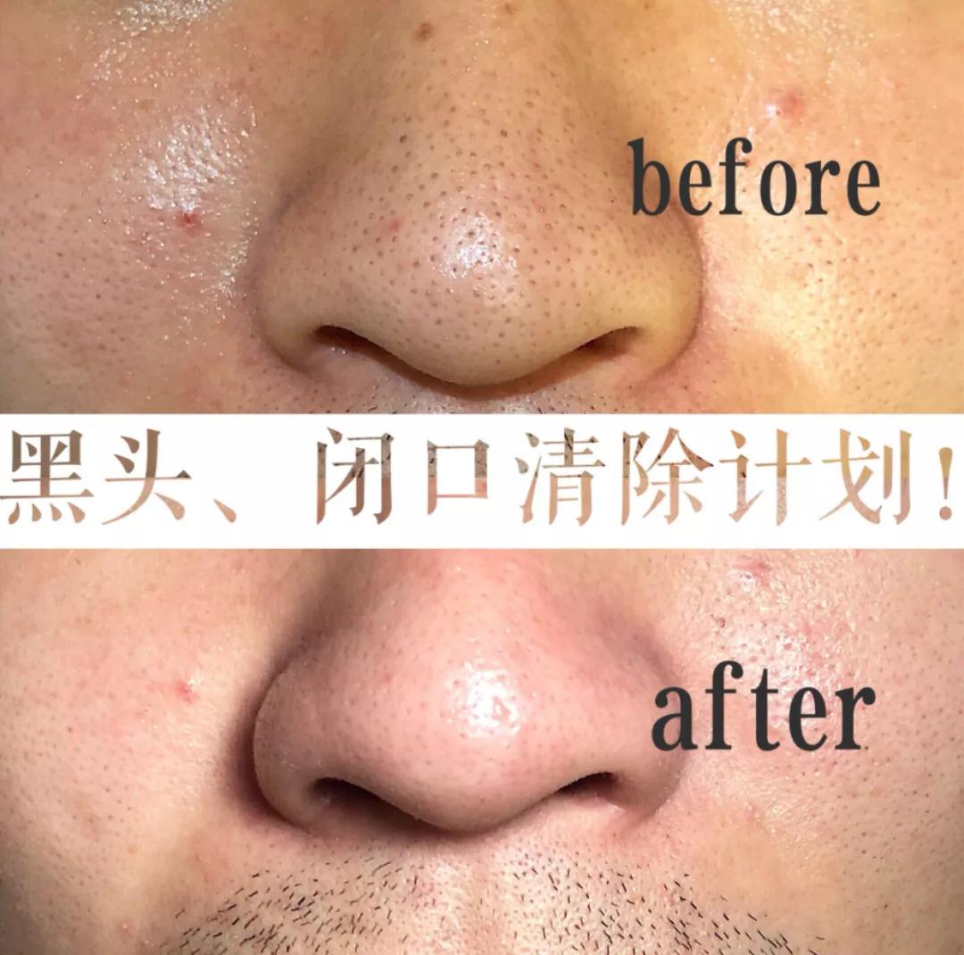 亲测真正有效去黑头粉刺产品,黑头连根拔起还会再长吗