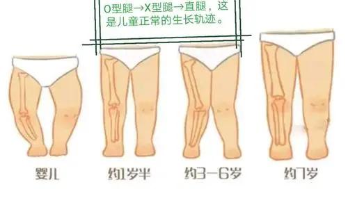 宝贝O型腿、X型腿?专家:不一定缺钙,也不能让纸尿裤背锅