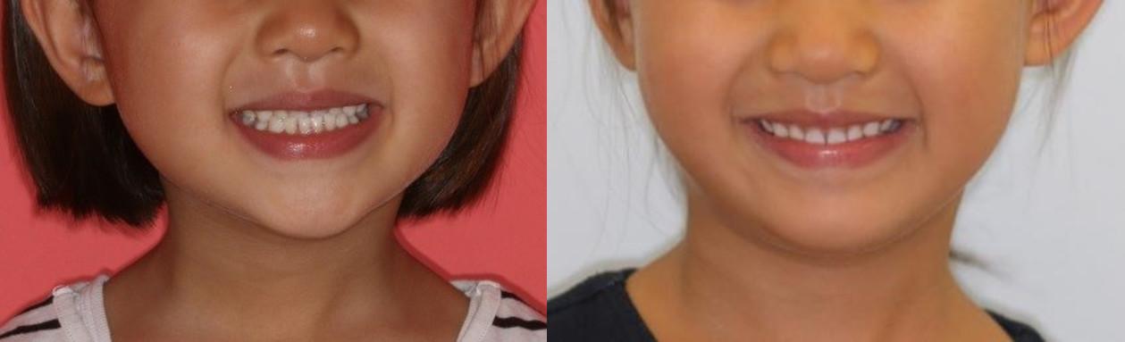 雅悦齿科,做了牙齿矫正容易得牙龈萎缩吗