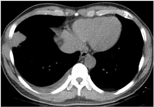 胸壁疼痛的典型特征,临床诊断胸痛是什么意思