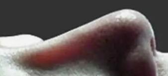 硅胶假体隆鼻透光怎么遮,硅胶隆鼻后鼻子反复肿