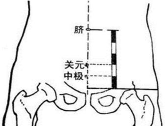 蕲艾灸为主,治疗宫颈Ca术后化疗致尿潴留(癃闭)案