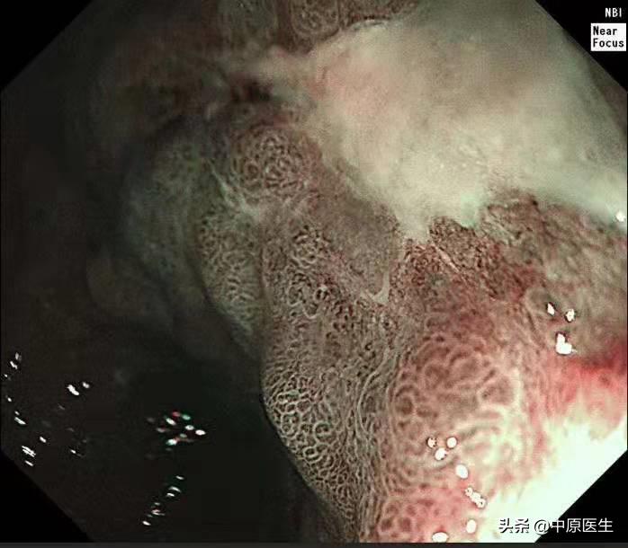 必须活检的胃溃疡:以为是胃溃疡,专家用另一方法放大发现是胃癌