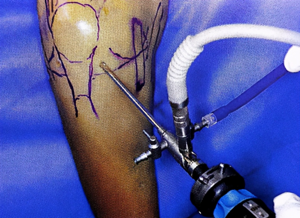 交叉韧带损伤患者科普,前交叉韧带损伤医生怎么问诊