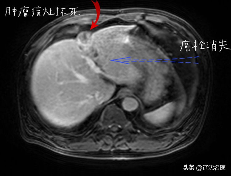 肝癌做放射性粒子治疗有什么影响,乏力查出来癌症