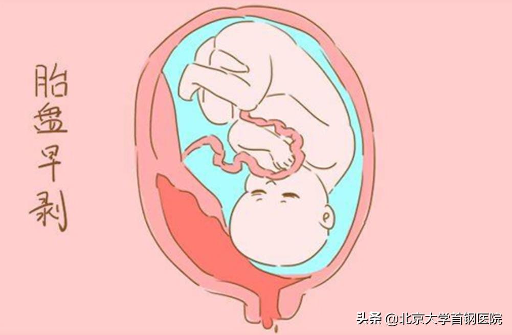 胎盘增厚是nt增厚吗,胎盘增厚会是胎儿畸形引起的吗