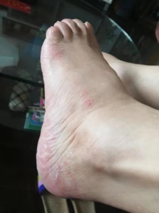 去角质灭真菌用什么,去角质最有效初学者