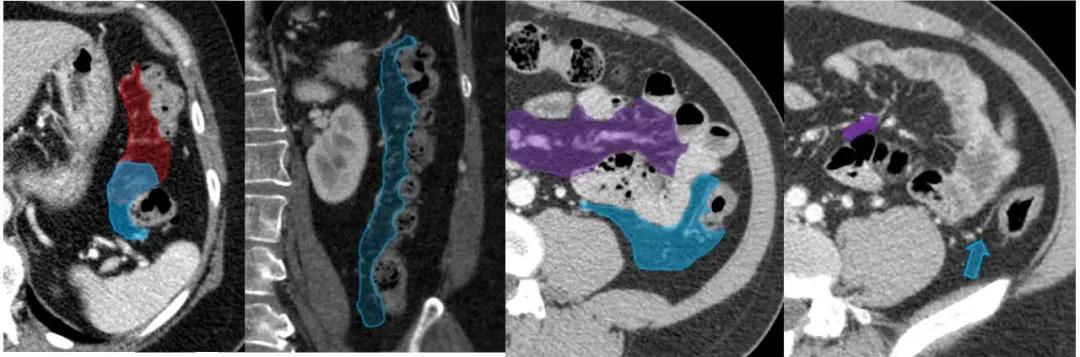 这样的解剖结构容易忘？重新认识肠系膜