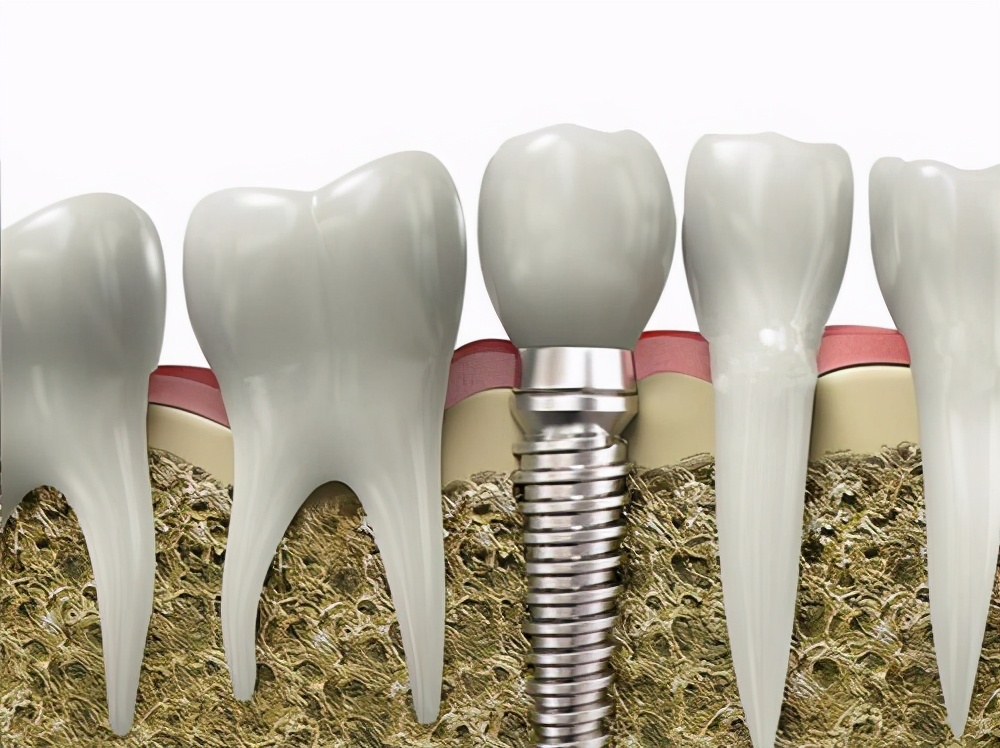 明星的牙齿都是种植牙,明星的牙齿是全种植牙吗