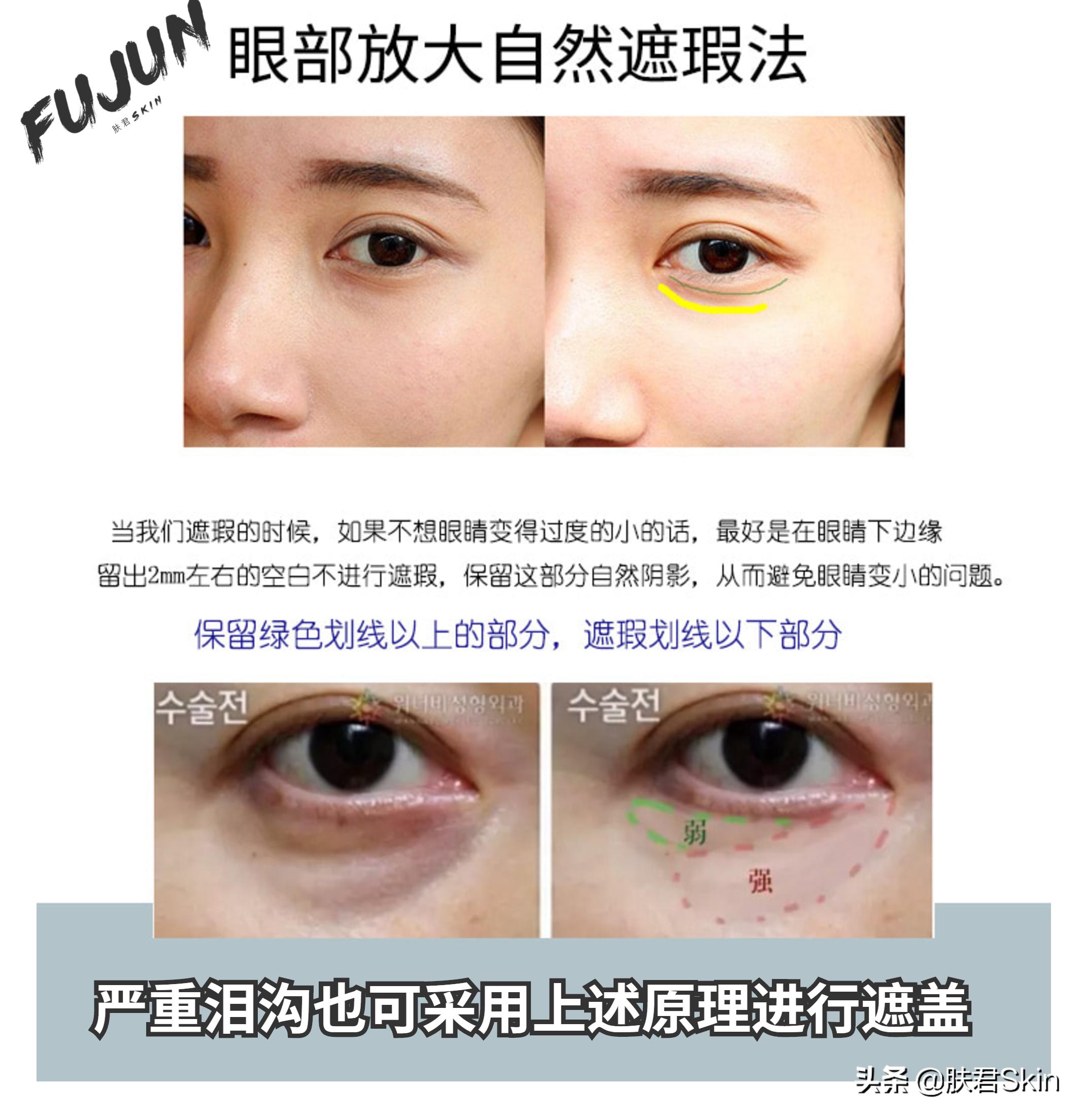 有什么沟必须火的,泪沟后面有一条很深的沟叫什么